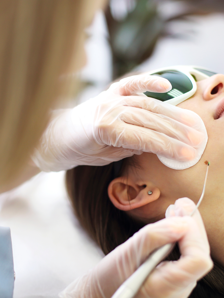 Affordable Microneedling Treatment in Bowness